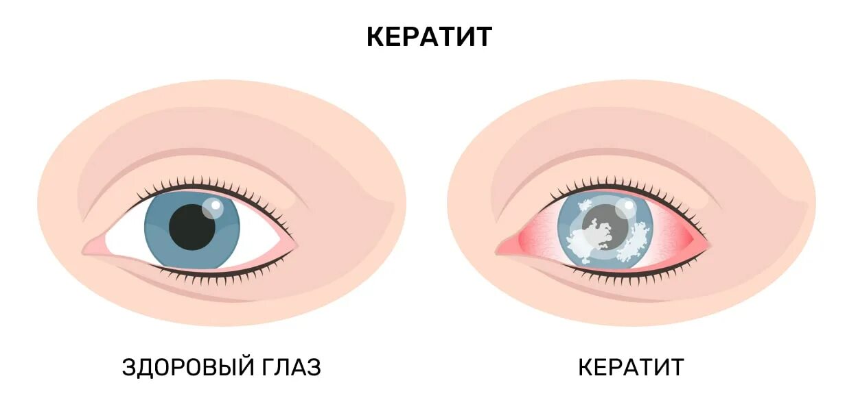 Лечение инфекции глаза у взрослых