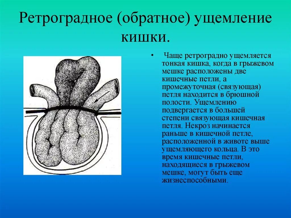 Ответы ущемленная грыжа. Ретроградное ущемление петли тонкого кишечника. Ретроградное ущемление кишки в грыже. Ретроградная ущемленная грыжа. Паховая грыжа ретроградное ущемление.