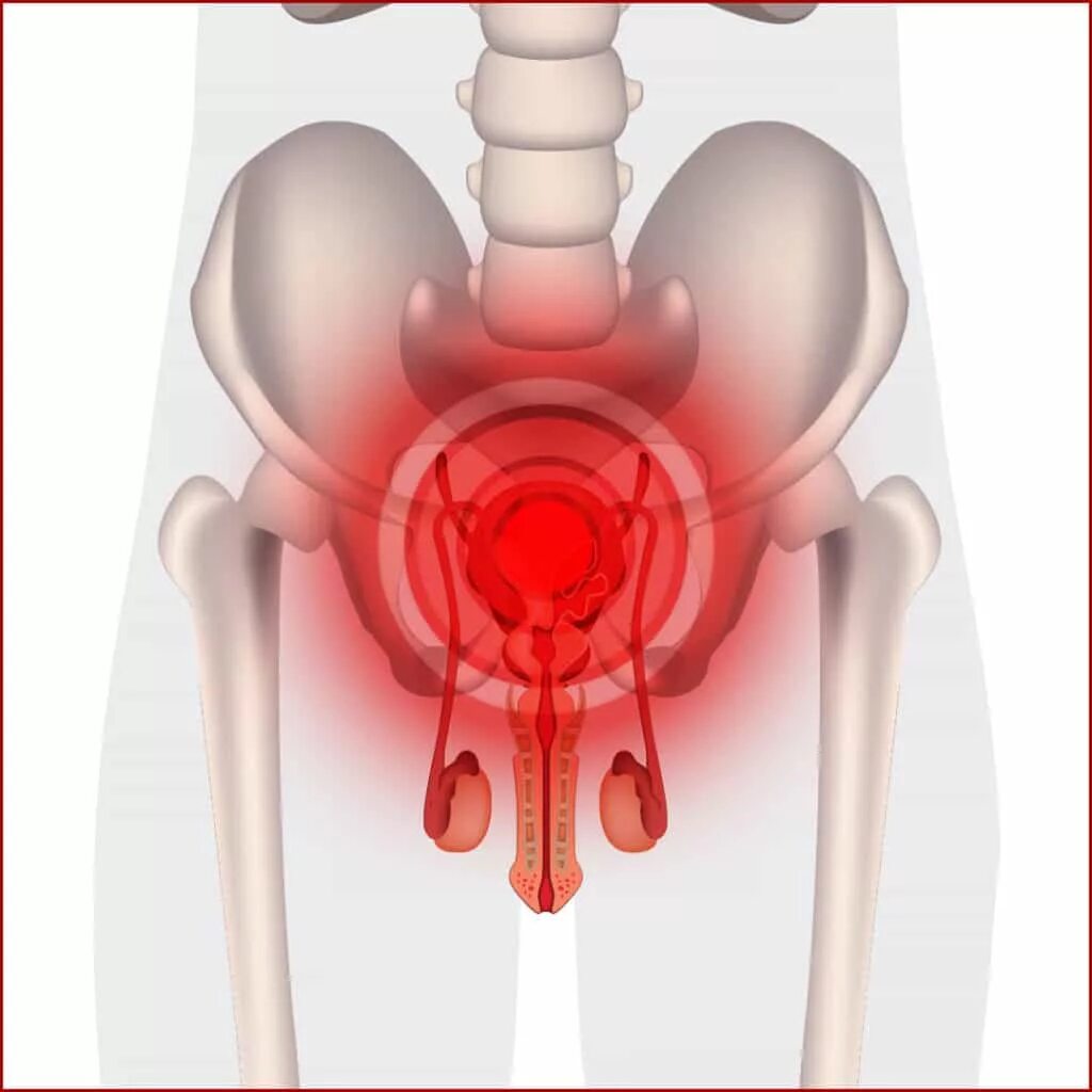 Жжение в простате. Цифровая медицина простатит.