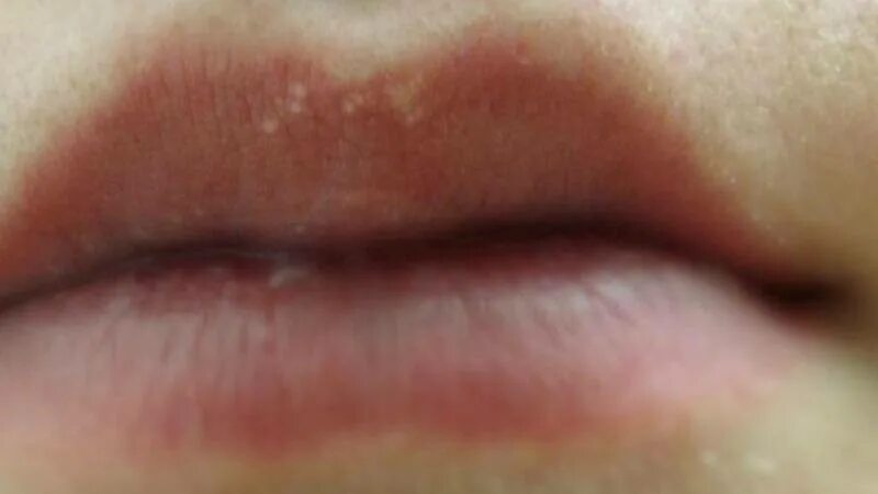 Персик форма половых губ у девушек. Ангулярный хейлит кандидоз.