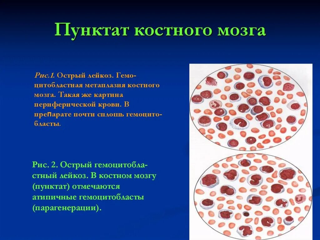 Вред костный мозг. Острый лейкоз костный мозг. Пунктат костного мозга при остром лейкозе. Острый лейкоз периферическая кровь. Пунктат костного мозга при остром миелолейкозе.