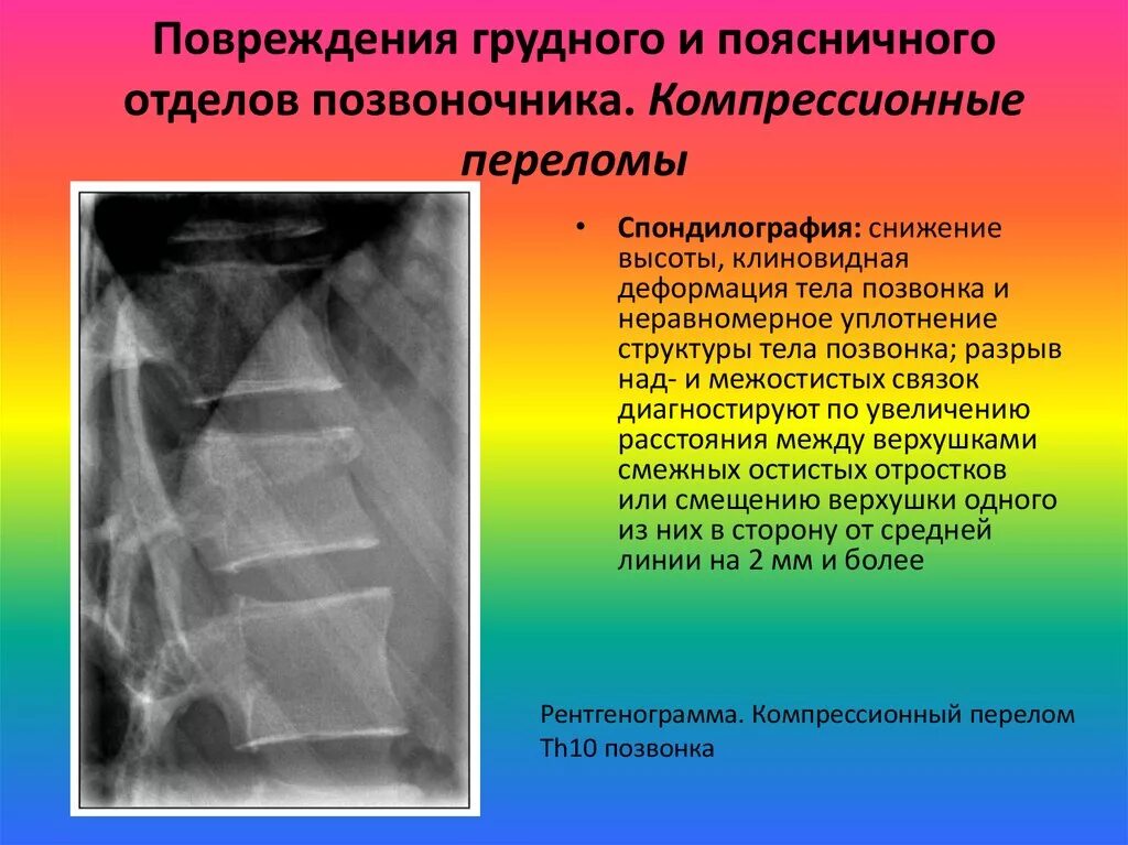 Компрессионный перелом грудного позвонка рентген. Компрессионный перелом тела позвонка степени рентген. Клиновидная деформация деформация позвонка. Передняя клиновидная деформация тела позвонка рентген. Осложнения перелома позвоночника