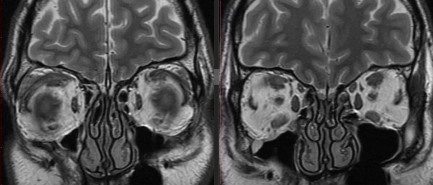 Глазных орбит и зрительных нервов. Мрт головного мозга и глазных орбит. Эндокринная офтальмопатия мрт. Мрт орбит и зрительных нервов. Мрт орбит глаз.