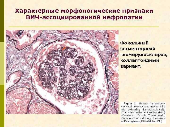 ВИЧ ассоциированная нефропатия. Сегментарный гломерулосклероз. Нефропатия при ВИЧ инфекции. Кожные изменения при ВИЧ.