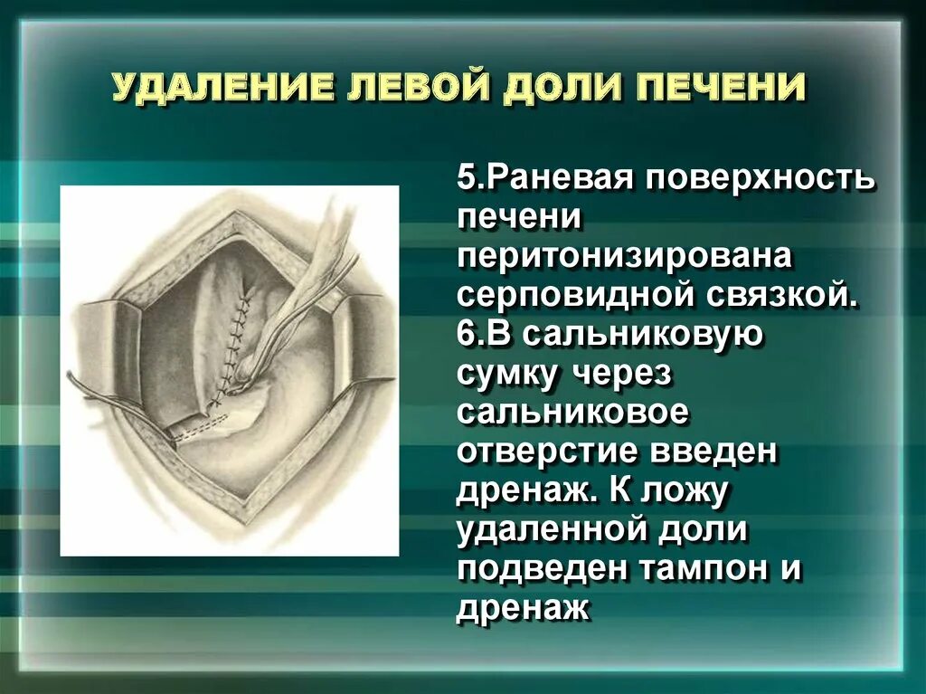 Операция по удалению печени. Резекция левой доли печени. Резекция печени операция. Плоскостная резекция печени.