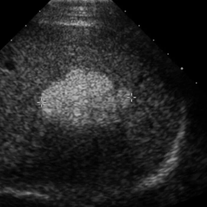 Эхогенность селезенки. Гиперэхогенные образования в печени на УЗИ. Гепатоцеллюлярная аденома печени УЗИ. Гиперэхогенный очаг в печени на УЗИ.