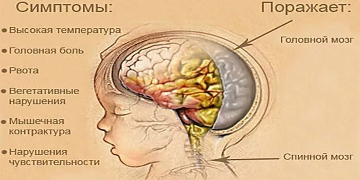 Как выглядит менингит у ребенка Не упустите время: как распознать менингит 30.05.2018, Sputnik Казахстан
