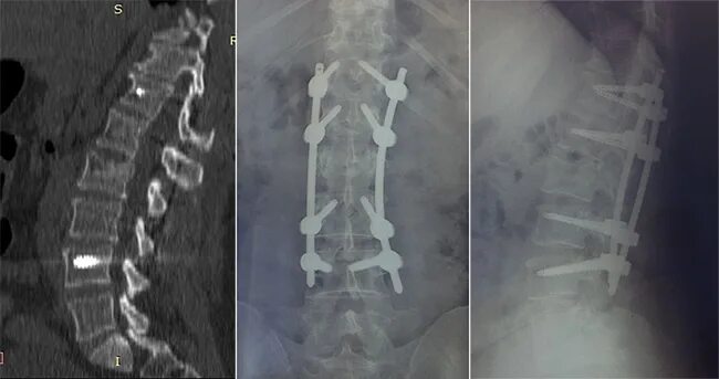 Компрессионный перелом l2 позвонка. Компрессионный перелом позвоночника л2. Компрессионный перелом л3 л4. Компрессионный перелом л1 позвонка.