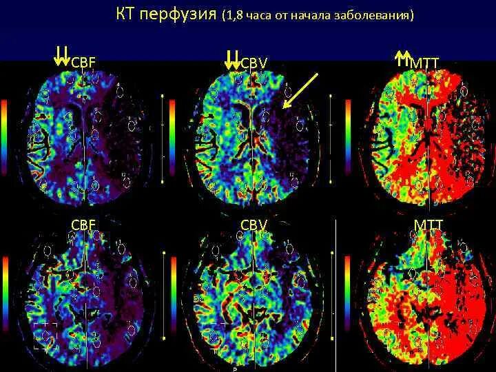 Магнитно-резонансная перфузия головного мозга. Перфузионное мрт. Мрт перфузия мозга. Кт перфузия головного мозга нормы. Кт перфузия инсульт.