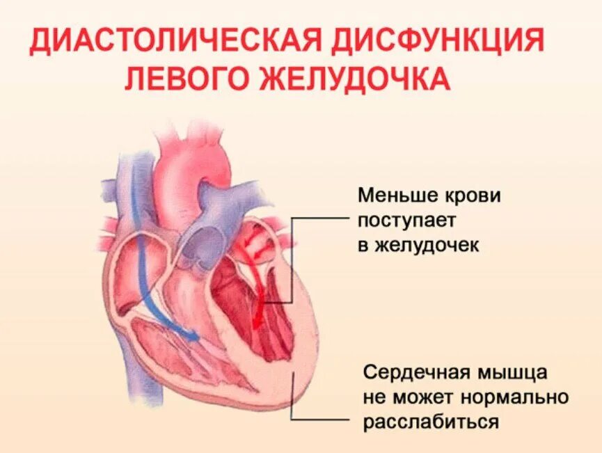 Нарушение диастолы левого желудочка. Диастолическая дисфункция левого желудочка 1 типа причина. Диастолическая дисфункция левого желудочка 2 степени. Типы дисфункции левого желудочка.