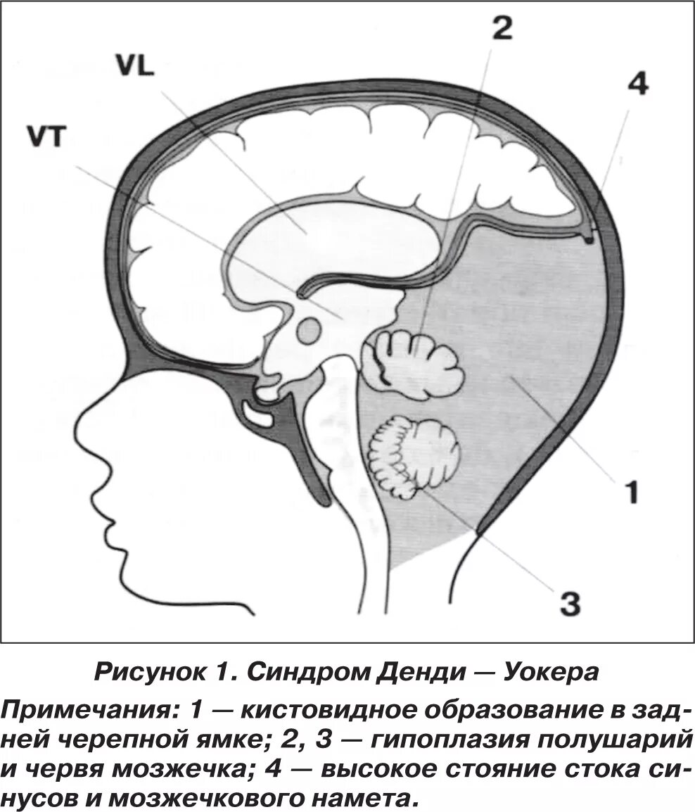 Мозжечок у плода норма