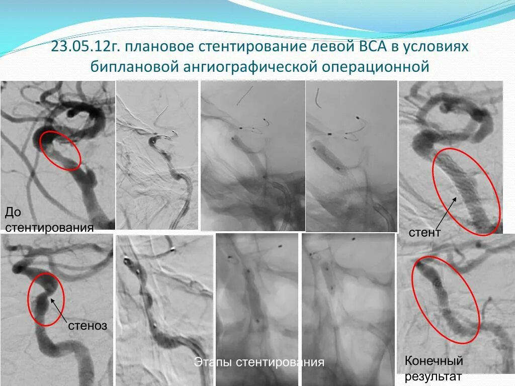 Коронарография стеноз. Коронарография сосудов стентирование. Стентирование коронарных артерий методика. Стентирование коронарных артерий схема. Стентирование прогнозы