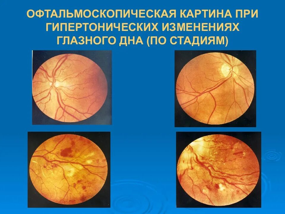 Болезнь глазного дна. Гипертоническая ретинопатия глазное дно. Стадии изменения глазного дна при гипертонической болезни. Гипертоническая нейроретинопатия глазное дно. Гипертоническая ангиопатия сосудов.