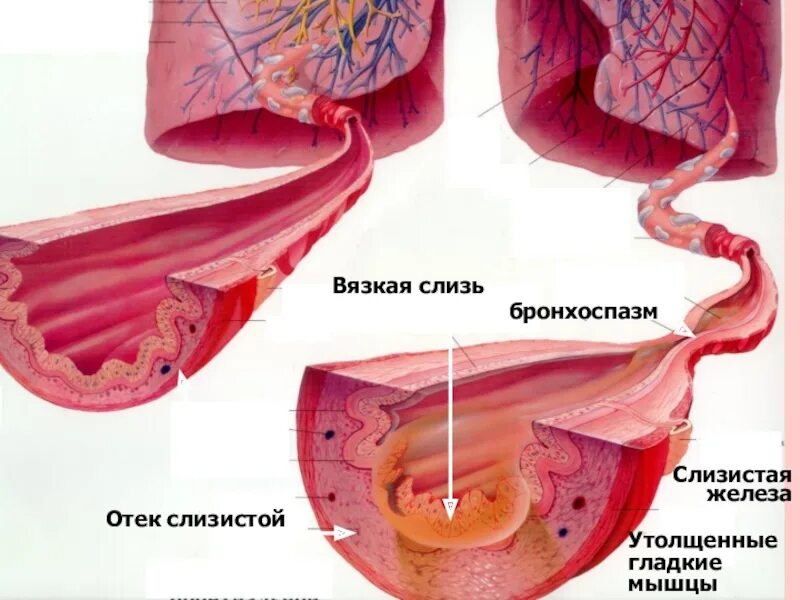 Альвеолярные мокроты