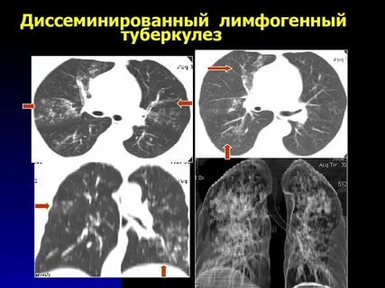 Диссеминированный кавернозный туберкулез