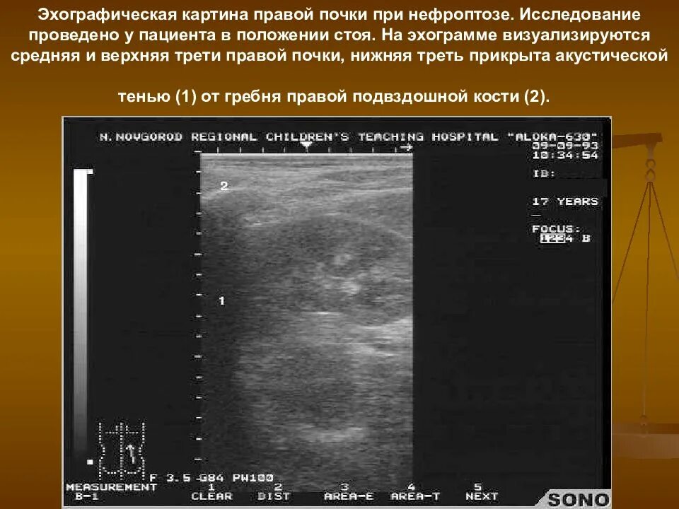 Диффузно неоднородное изменение синусов почек. Диффузно неоднородное изменение синусов почек