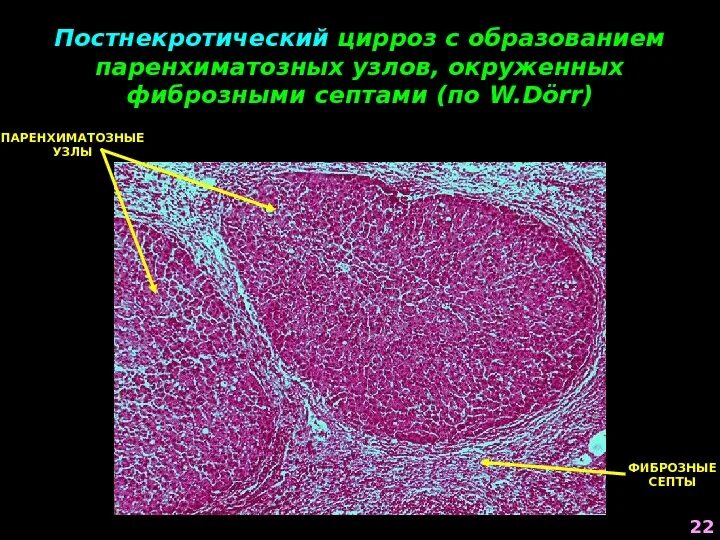 Патологическая анатомия при циррозе печени. Крупноузловой цирроз печени патанатомия. Билиарный цирроз печени патанатомия. Макронодулярный цирроз печени.