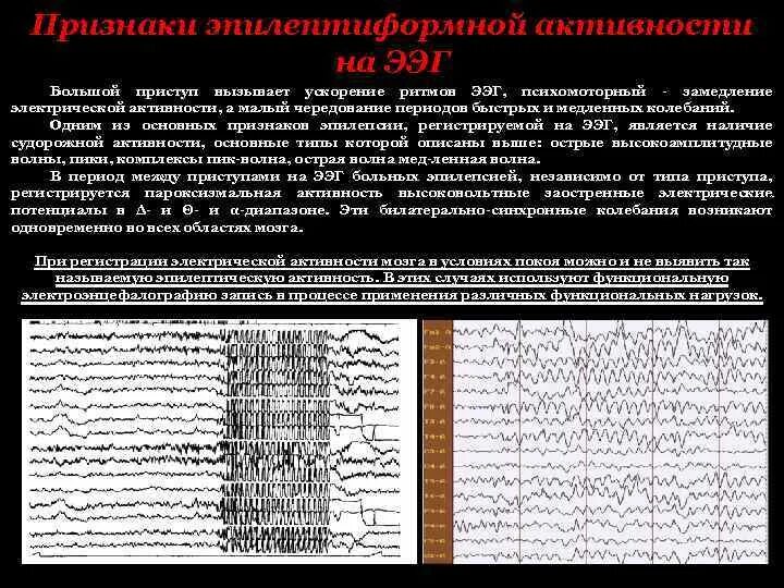 Описание ээг. ЭЭГ показатели больного эпилепсией. Эпиактивность на ЭЭГ. Эпилептиформная активность на ЭЭГ У ребенка что это. Эпилептиформные паттерны на ЭЭГ.