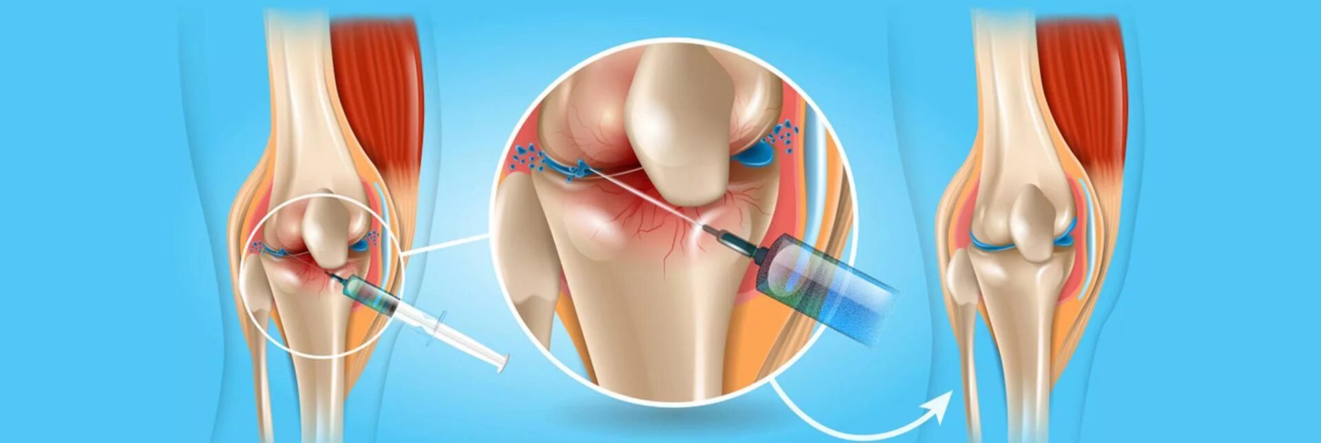 Синовиальная жидкость в коленном суставе. Пункция коленного сустава. Синовиальная жидкость в мениске. Операция коленный сустав новосибирске