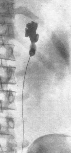 Рентген мочеточника. Аплазия мочеточника рентген. Гипоплазия мочеточника рентген. Аплазия почек рентгенодиагностика.