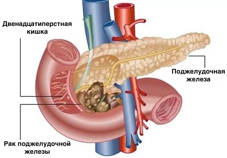 Раковая опухоль поджелудочной железы. РПК поджелудочной железы симптомы. Новообразование головки поджелудочной железы. Поджелудочной железы (опухоли и панкреатит);.
