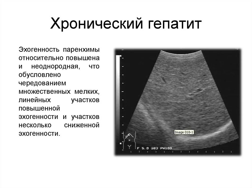 Печень диффузно неоднородная что это. Хронический гепатит УЗИ картина. УЗИ признаки хронического гепатита. УЗИ критерии хронического гепатита. Хронический гепатит б на УЗИ.