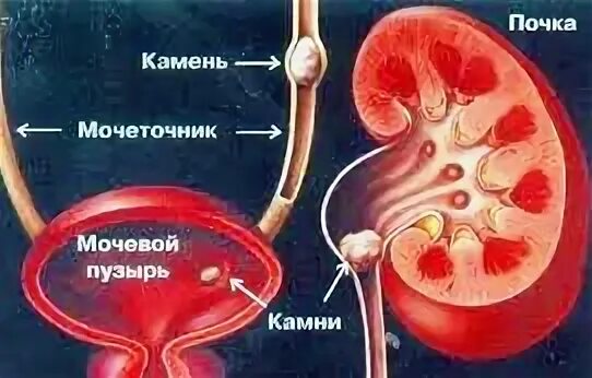 Камень застрял в мочеточнике симптомы
