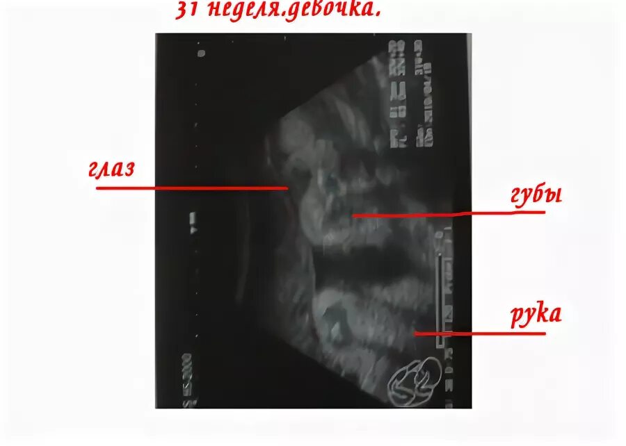 Сердцебиение плода у мальчиков. ЧСС плода на сроке 12 недель. Сердцебиение в 12 недель и пол ребенка. Сердцебиение по УЗИ мальчика и девочки.