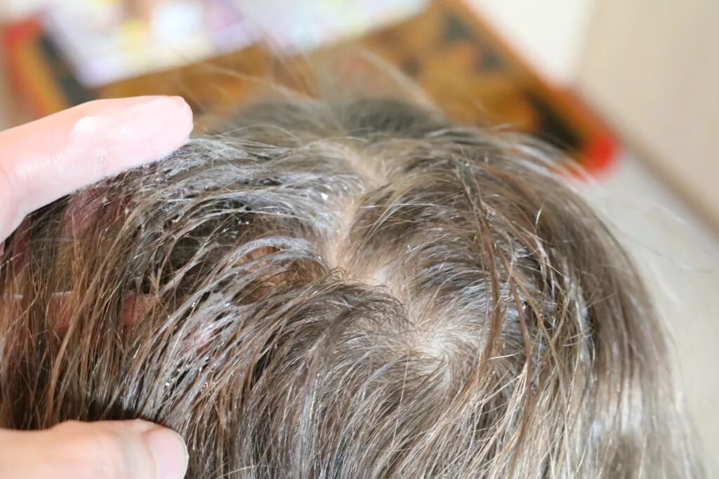 что делать после вшей. что делать после вшей. педикулез волосистой части головы. вычесывание вшей и гнид. что делать после вшей.