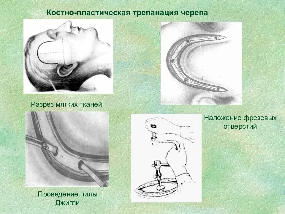 Инструменты для костно пластической трепанации черепа. Костно пластическая Трепанация черепа инструментарий. Костно-пластическая Трепанация черепа по Оливекрону. Хирургические инструменты для костно пластической трепанации черепа.