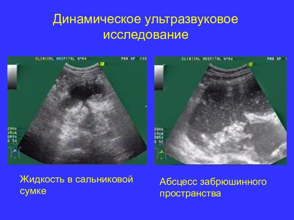 Ультразвуковое исследование забрюшинного пространства