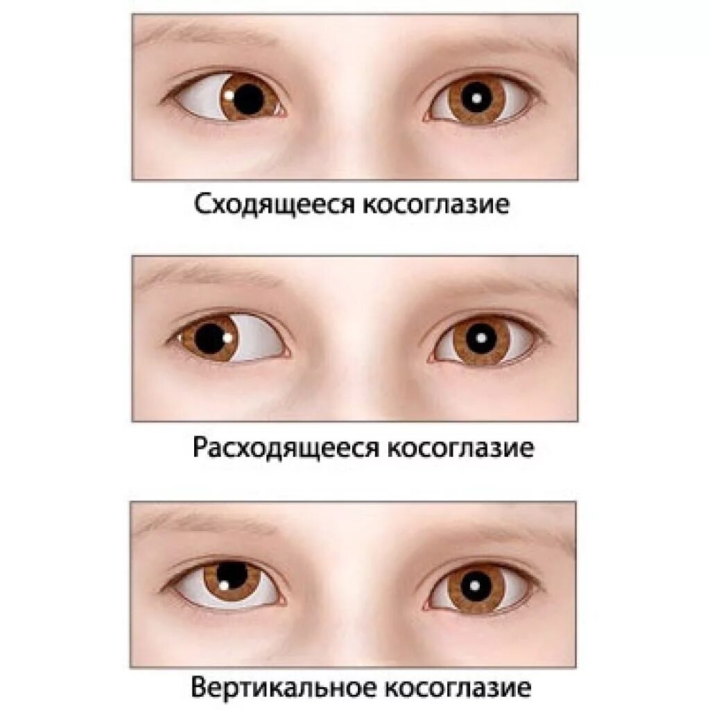 У ребенка зрение 1 5. Сходящееся и расходящееся косоглазие. Эзотропия сходящееся косоглазие. Упражнения для исправления косоглазия.