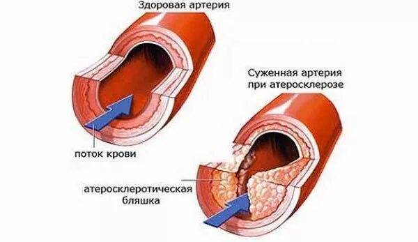 Сосуды сужаются давление. При повышенном давлении сосуды сужены. При повышении давления сосуды расширяются.