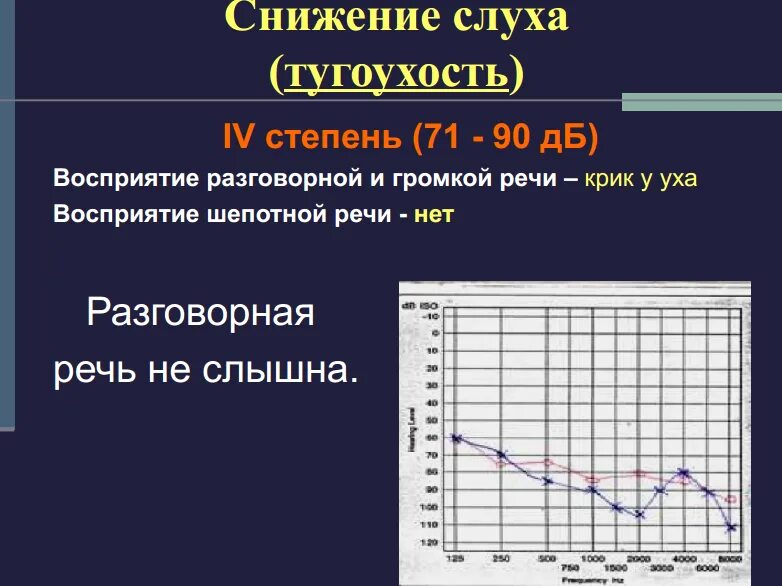 Степень снижения слуха классификация. Тугоухость iv степени. Степени тяжести тугоухости таблица. Степени тяжести тугоухости таблица. Тугоухость 1 степени аудиограмма.