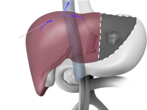 Операция резекция печени. Бисегментэктомия печени. Оперативные вмешательства на печени. Резекция печени операция.