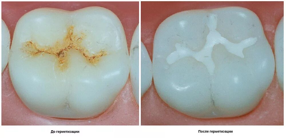 1 запломбировать 2 новостей 3 одолжить. Фиссурный кариес пломба. Фиссурный кариес молочных зубов. Цементная пломба Фуджи.