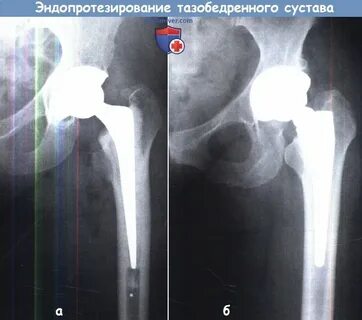 Тотальное эндопротезирование суставов