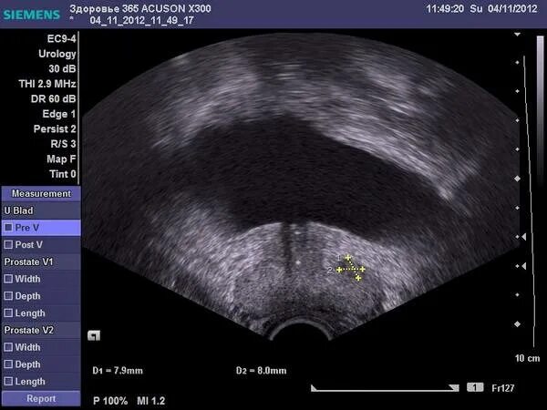 Трансректальное УЗИ простаты. Трузи предстательной железы. Аденоматозный узел предстательной железы. Трансректальное УЗИ мочевого пузыря. Трузи предстательной железы как делают