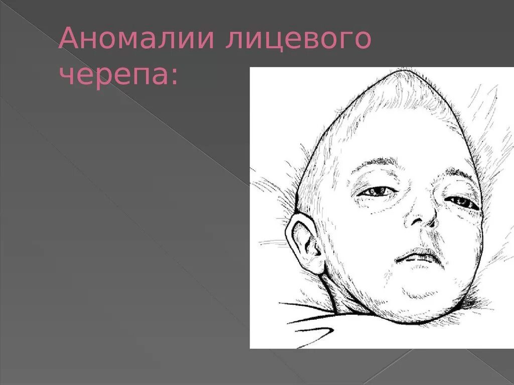 Черепная аномалия. Врожденные аномалии костей черепа. Аномалии развития лицевого черепа. Пороки развития костей черепа. Врожденные пороки развития лицевого черепа.