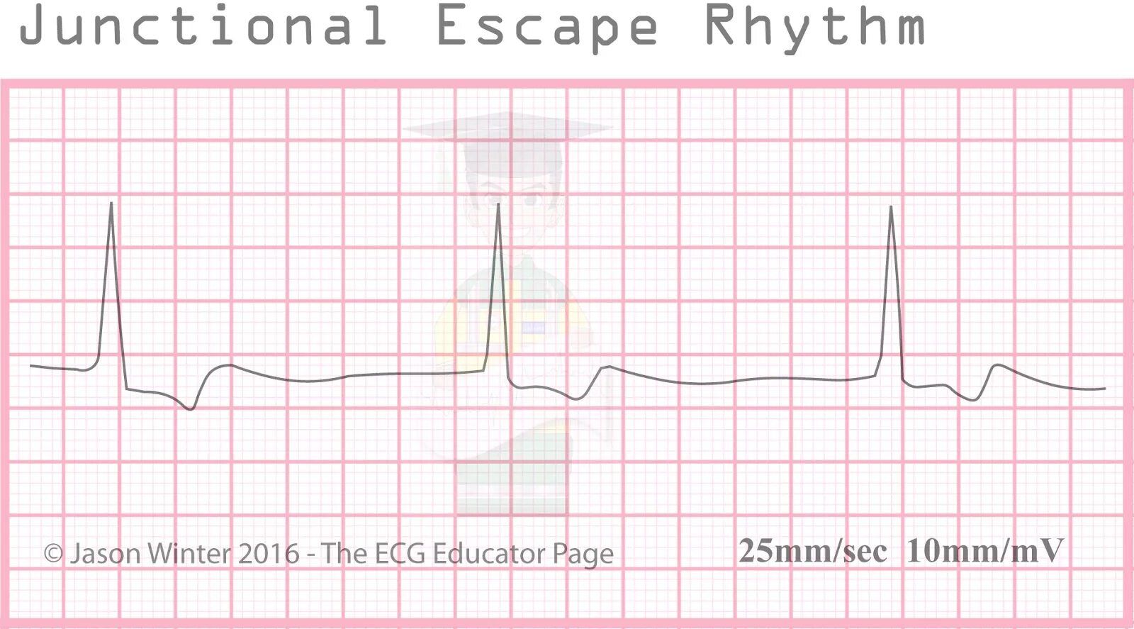 Sinus arrhythmia. Ekg atrial pacemakerrhythm. Пушечный ритм в медицине. Amathole rhythm. Экг при отеке легких.