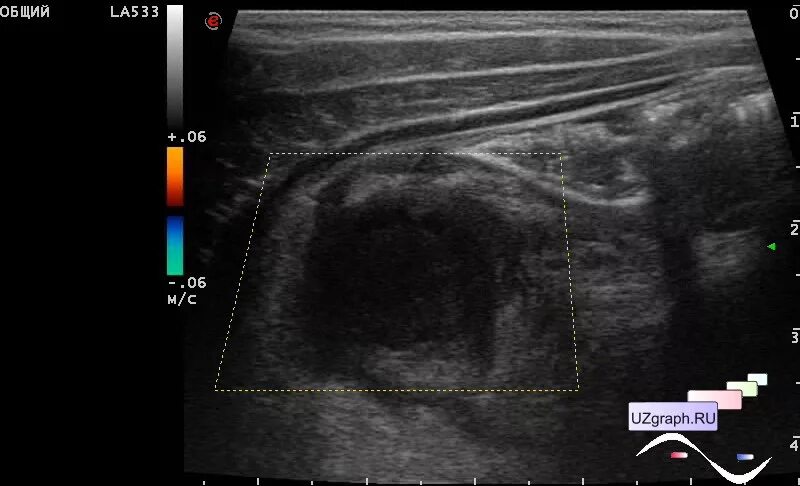 эмпиема желчного пузыря клиника. узи критерии острого холецистита. калькулезный холецистит узи заключение. флегмонозный холецистит узи. жировой гепатоз печени при узи.