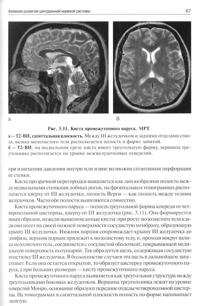 Чем опасна киста в мозгу. Киста промежуточного пар Уса кт. Киста промежуточного паруса мрт. Арахноидальная киста промежуточного паруса. Мрт мозга киста промежуточного паруса.