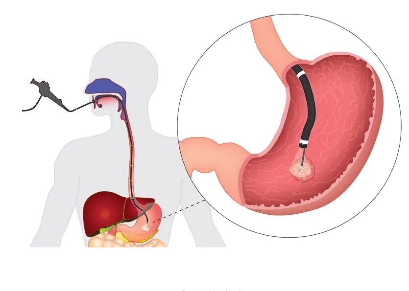 Гастроскопия желудка гастрит. ЭГДС желудка гастроскопия. Гастроскопия желудка что это