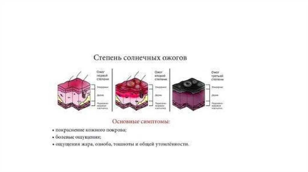 Установите соответствие степени ожога. Солнечный ожог 2 и 3 степени. Солнечные ожоги 1 и 2 степени. 2 Степень солнечных ожогов. Солнечный ожог 2 степени признаки.