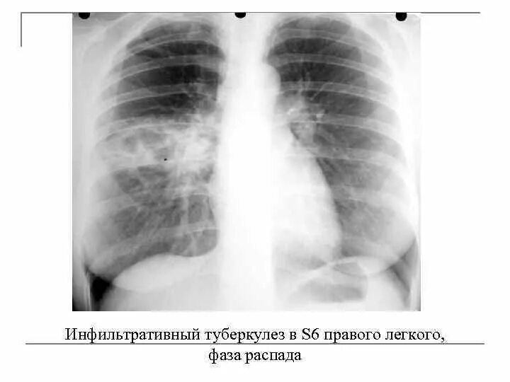 Инфильтративный туберкулез легкого с1-2. Инфильтративный туберкулез рентген. Инфильтративный туберкулез с распадом рентген. Инфильтративный туберкулез s6.