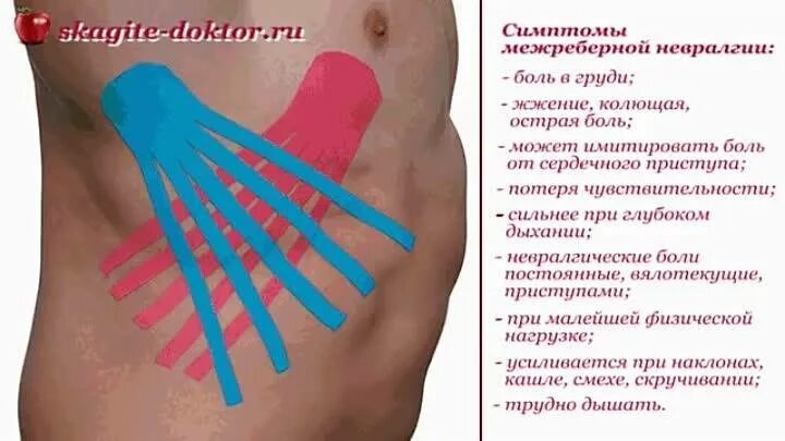 Невралгия при вдохе. Межреберная невралгия боль. меж рёберная невралгия. межреберная невралгия симптомы. межреебернаяневролгия.