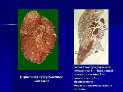 Первичный туберкулезный аффект