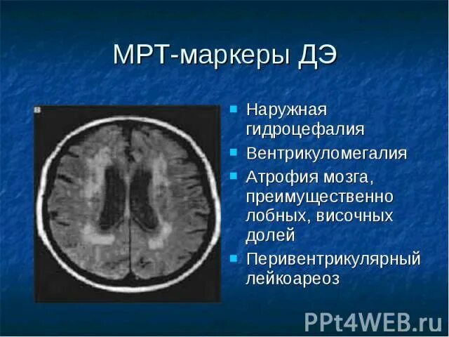 Наружная гидроцефалия головного мозга мрт. Кт атрофия мозга наружная гидроцефалия. Лейкоареоз головного мозга на кт. Лейкоареоз на кт.