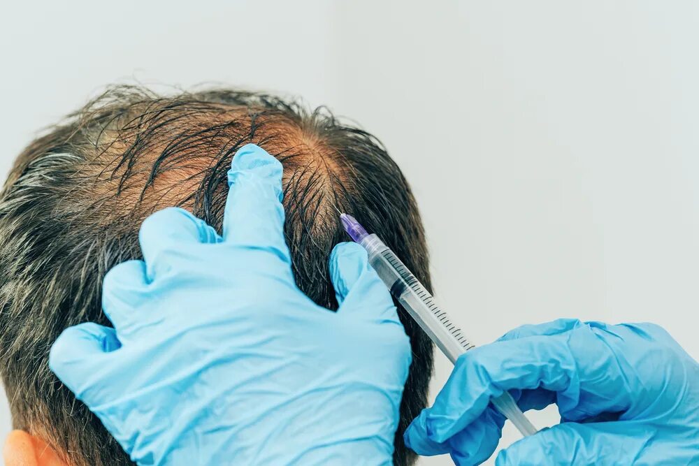 Инъекции головы. Мезотерапия для волос. Мезотерапия головы. Мезотерапия волос мужчин.