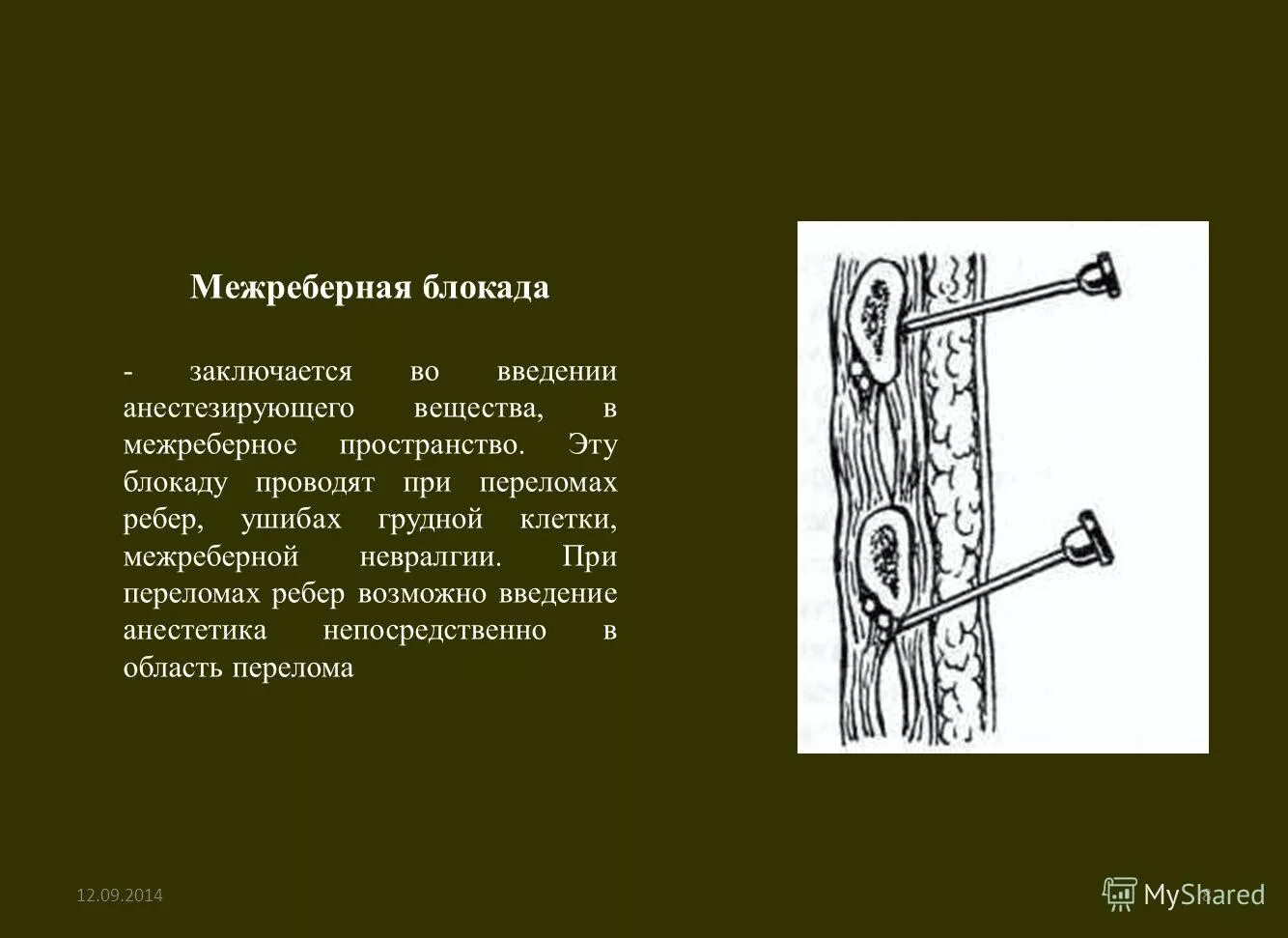 Межреберная блокада. Блокада при переломе ребер. Межреберная блокада техника. Межреберная блокада методика.